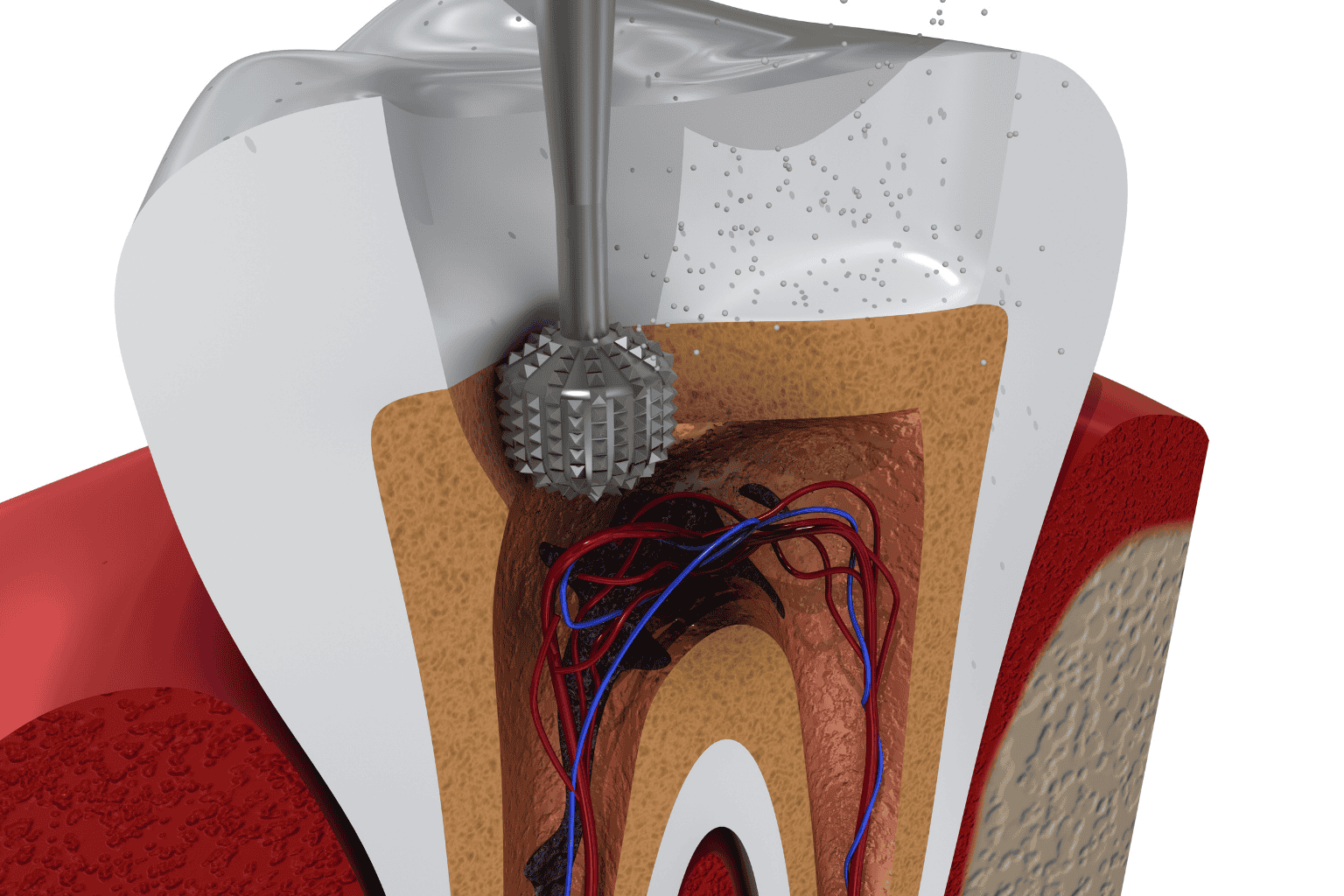 Root Canal Treatment
